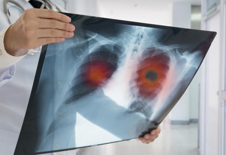 Lung Cancer medicine Mobocertinib got positive result for early trial