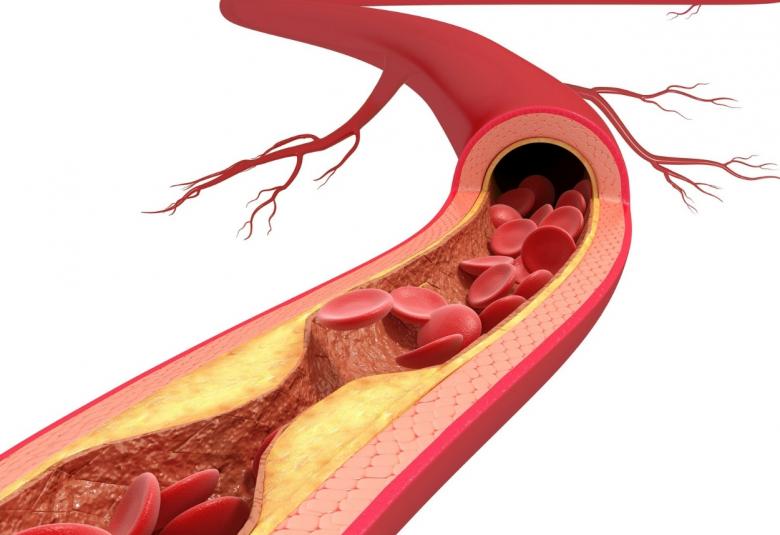New synthetic peptides could attenuate atherosclerosis