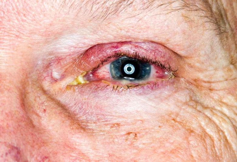 Mucormycosis, symptoms, diagnosis and treatment