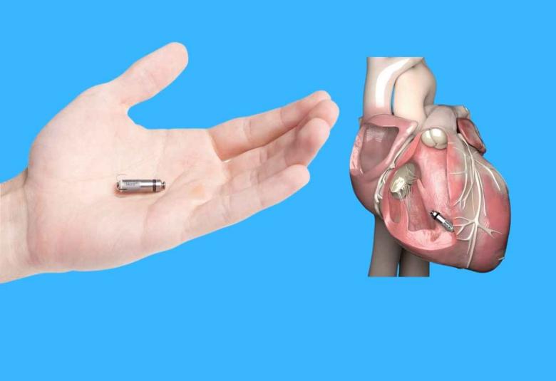 Medtronic launches smallest pacemaker with Atrioventricular synchrony