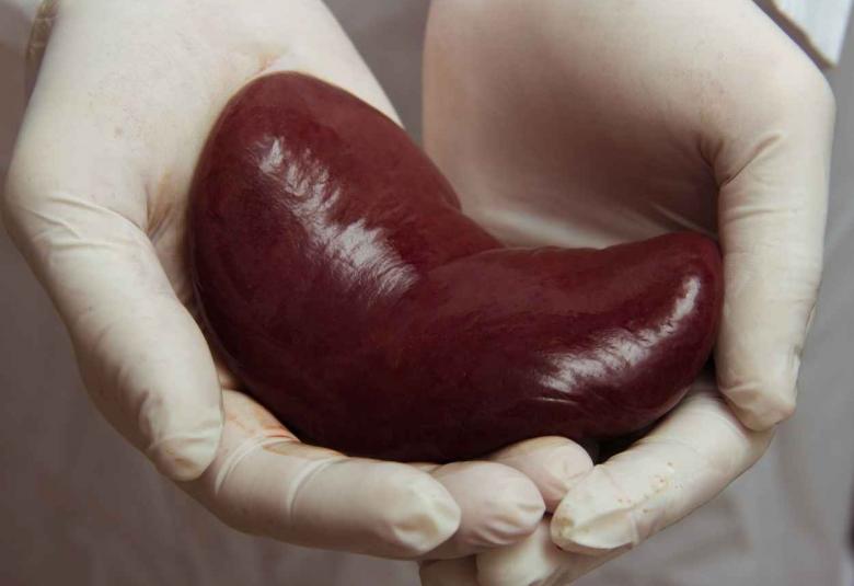 Vifor Pharma andAngion Biomedica Corp announced that the phase-III trial of Angions ANG-3777 
