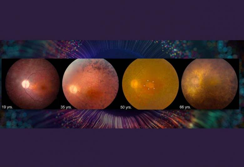 Retinoid Therapy May Improve Vision in People with Rare Genetic Disorder