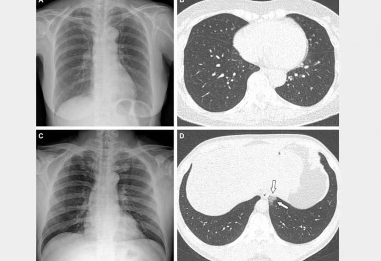 COVID-19 less severe in vaccinated