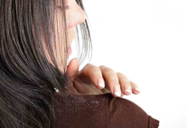 FACTOR AFFECTING ON THE DANDRUFF GROWTH AND THE IMPACT OF NATURAL HERBS AS AN ANTI-DANDRUFF AGENT