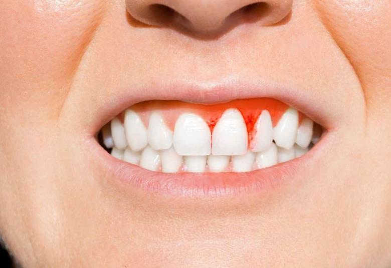 PvPI reveals new adverse drug reaction of Tacrolimus