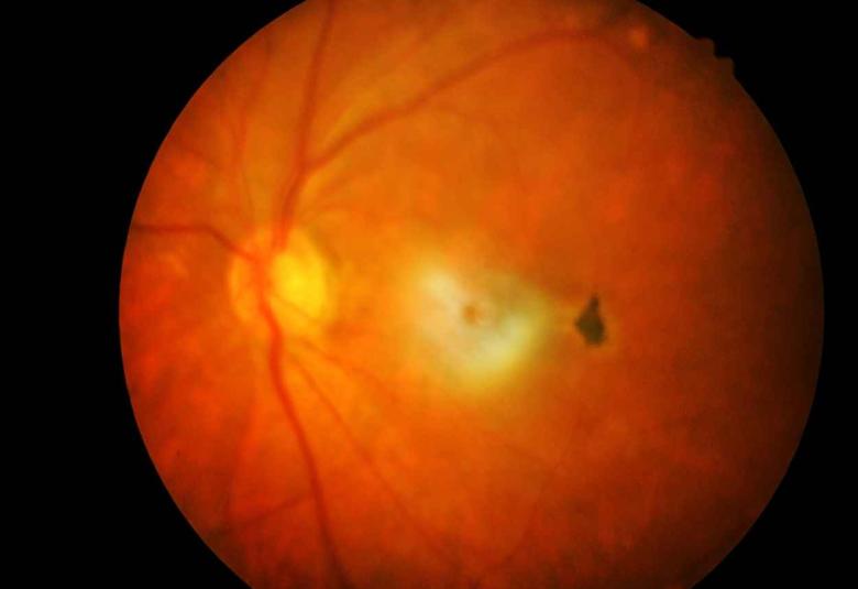 Nanoscope Therapeutics Receives Fast Track Designation by the FDA for MCO-010 for the Treatment of Retinitis Pigmentosa