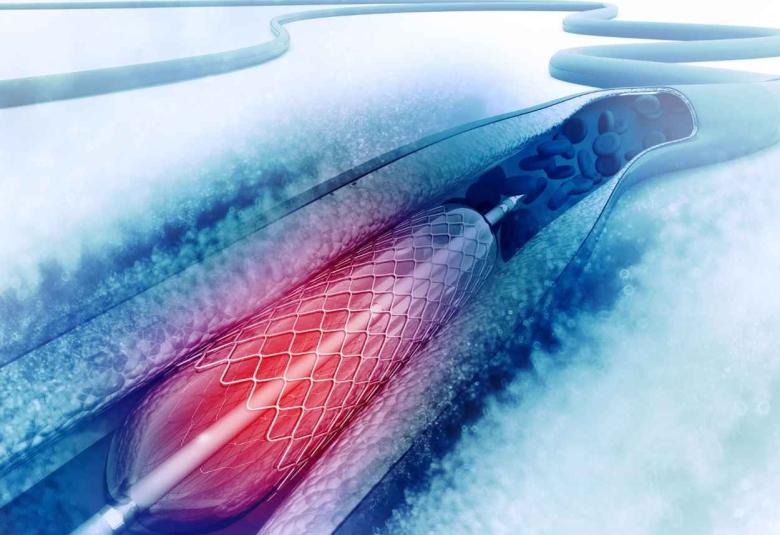NPPA notified ceiling prices of cardiac stent remains same as earlier