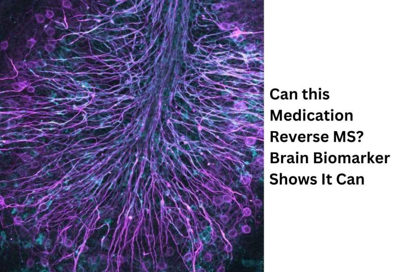 Scientists identified an over-the-counter antihistamine as a treatment for multiple sclerosis