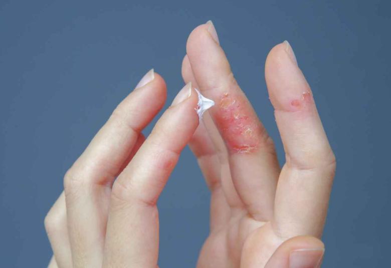 Inflammatory Bowel Disease Linked to Atopic Dermatitis