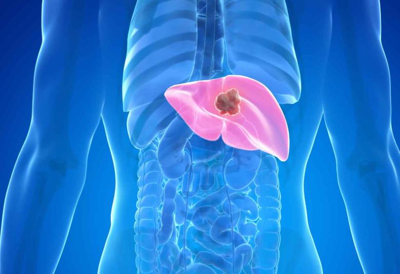 Treating liver cancer with microrobots piloted by a magnetic field