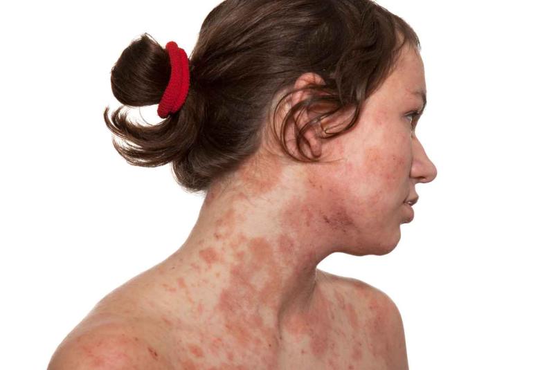 More than two-thirds of people with atopic dermatitis and skin of color experienced skin improvement in a first-of-its-kind lebrikizumab study