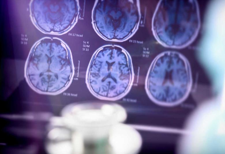 UCSD develops gene therapy that preserves memory in Alzheimer’s mouse models