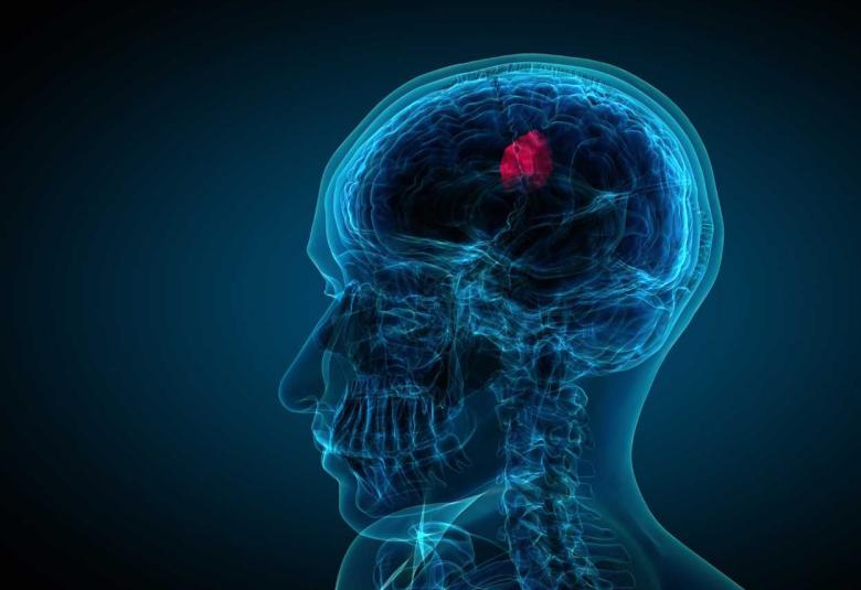 Breakthrough Study Reveals FAM111B as a Potent Driver of Aggressive Brain Tumors