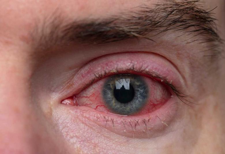 AAVantgarde Bio announces FDA Fast Track Designation for AAVB-039 for the Treatment of Stargardt Disease