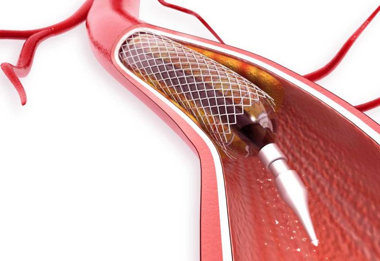 Individuals with diabetes are more likely to suffer complications after stent surgery