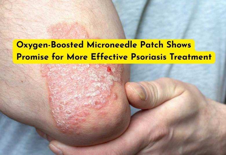 Oxygen-Boosted Microneedle Patch Shows Promise for More Effective Psoriasis Treatment