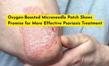 Oxygen-Boosted Microneedle Patch Shows Promise for More Effective Psoriasis Treatment