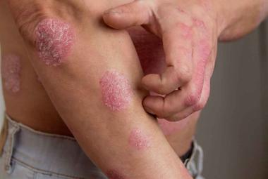 Psoriasis not caused by spontaneous mutations in skin cells