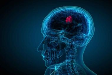 FDA Approves First Therapy for Rare Type of Non-Cancerous Tumors