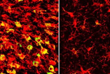 Lowering a form of brain cholesterol reduces Alzheimer’s-like damage in mice
