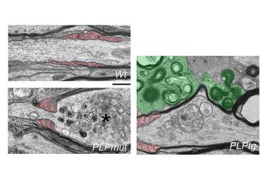 Neurodegeneration in Myelin Disease : No Myelin is Better than Bad Myelin