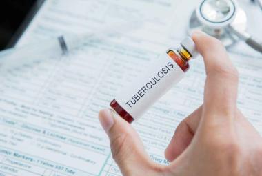 Researchers Develop a New Model by Leveraging an Old Vaccine to Build Better Tuberculosis Vaccines