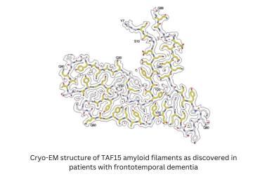 Protein found in brain linked to frontotemporal dementia