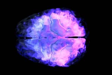 Researchers map how measles virus spreads in human brain