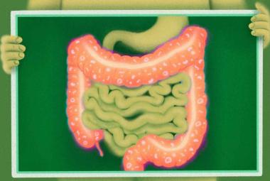 Researchers identify why cancer immunotherapy can cause colitis