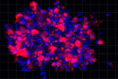 Scientists Use Organoid Model to Identify Potential New Pancreatic Cancer Treatment