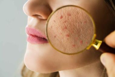 Barrier Repair - A trend in Cosmetics Formulation