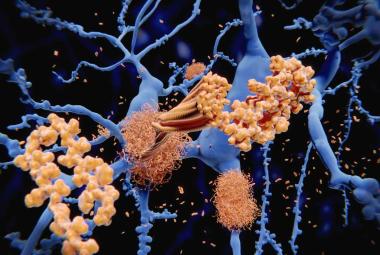 Lighting up Alzheimer’s-related proteins to allow for earlier disease detection