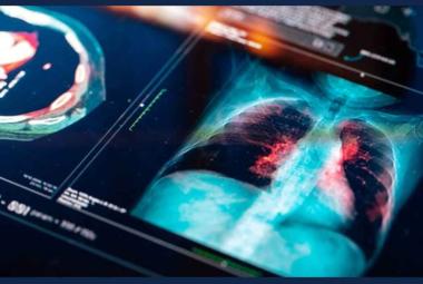 New treatment for a rare and aggressive cancer improves survival rates in breakthrough clinical trial 