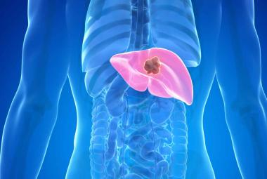 Treating liver cancer with microrobots piloted by a magnetic field