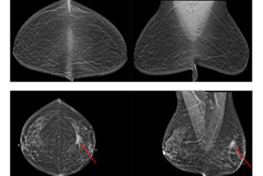 AI-assisted breast-cancer screening may reduce unnecessary testing