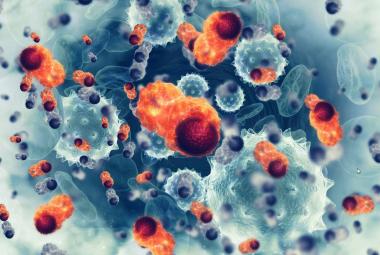 CAR T cell therapy targeting HER2 antigen shows promise against advanced sarcoma in phase I trial