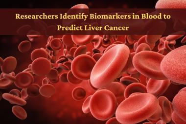 Researchers Identify Biomarkers in Blood to Predict Liver Cancer