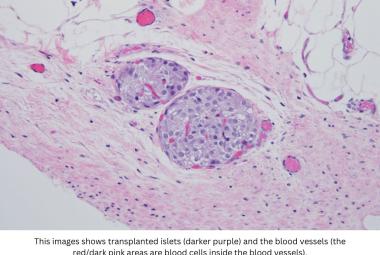 Antioxidant gel preserves islet function after pancreas removal