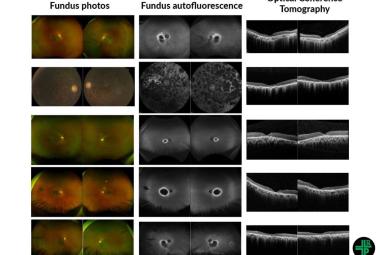 Scientists discover gene responsible for rare, inherited eye disease