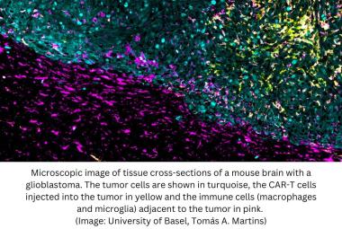 Glioblastoma : new treatment attacks brain tumors from multiple angles