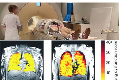 New scan method unveils lung function secrets