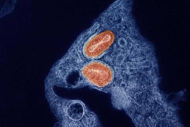 NIH Study Finds Tecovirimat Was Safe but Did Not Improve Mpox Resolution or Pain