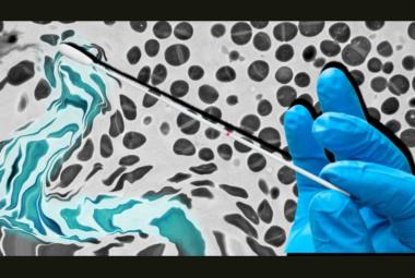 Stanford scientists transform ubiquitous skin bacterium into a topical vaccine