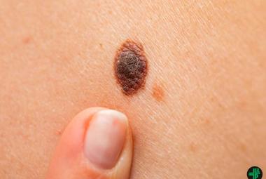 BMS melanoma drug failed in clinical trial