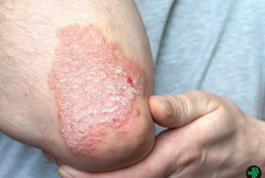 New Case Western Reserve University study identifies key protein’s role in psoriasis