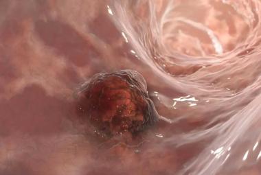 Bacteria leaking across stomach lining could indicate risk of gastric cancer, study finds