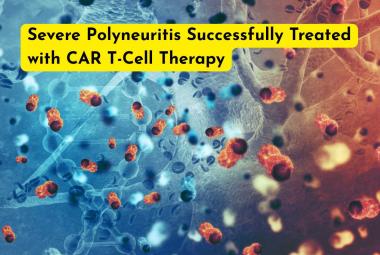 Severe Polyneuritis Successfully Treated with CAR T-Cell Therapy