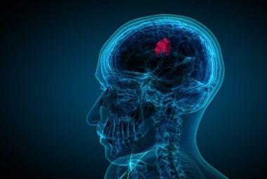Breakthrough Study Reveals FAM111B as a Potent Driver of Aggressive Brain Tumors