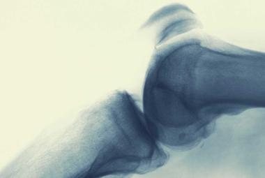 A potential way to relieve arthritic knees without drugs or surgery