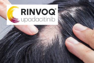 AbbVie RINVOQ Shows Promising Results in Phase 3 Trial for Severe Alopecia Areata